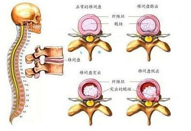 董双海医生讲堂 腰椎间盘突出症常见的几种手术方法