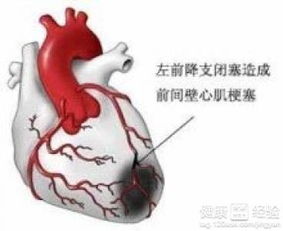 心肌梗塞的原因(心肌梗塞是什么原因引起的)