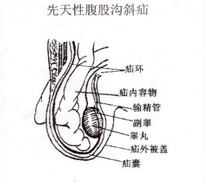 腹股沟疝是怎么回事啊？对孩子的影响大吗？