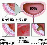 男性膀胱炎发病的原因是什么？