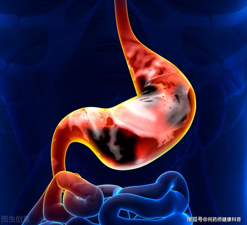 胃里面长了息肉会癌变 一般有哪些表现 可通过什么方法查出来