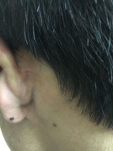 左耳朵长痣的位置图解