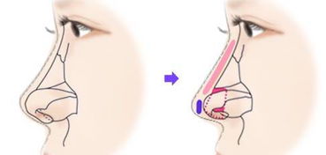 整形百科笔记之 隆鼻手术必备知识