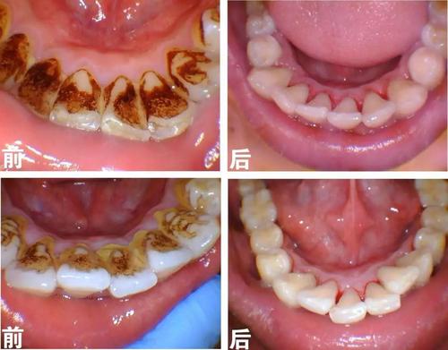 牙医总让你洗牙,到底是为啥