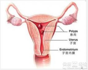 子宫内膜息肉是要做宫腔镜还是做腹腔镜(子宫内膜息肉是要做宫腔镜还是做腹腔镜好)