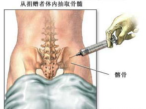 骨外科手术图库 骨髓移植术 手术过程 图片