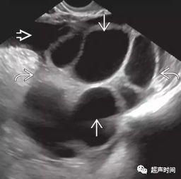 卵巢黄素囊肿 究竟是多房性还是多发性