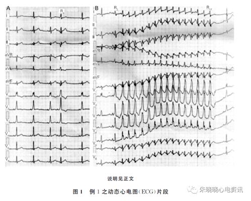 极易误诊为室性心动过速的几种情况