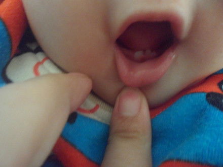 宝宝的小牙怎么长成这样 好奇怪
