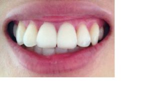 门牙做了氧化锆全瓷牙后用舌头舔到觉得不如真牙光滑是没做好吗 