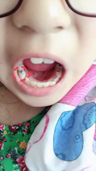 这颗牙是乳牙吗 