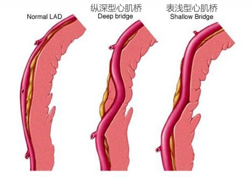 做冠脉CT检查出 心肌桥 ,这种 桥 你了解吗