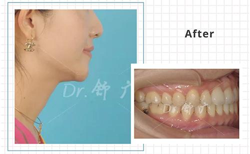 隐适美亚太讲师Dr.舒广 牙齿矫正拔牙与不拔牙病例分享