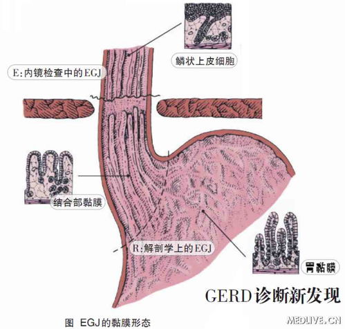 胃食管反流病新进展