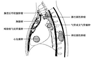 原发性纵隔肿瘤临床表现与诊断 