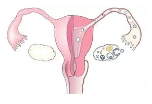 输卵管阻塞 输卵管阻塞怎么办