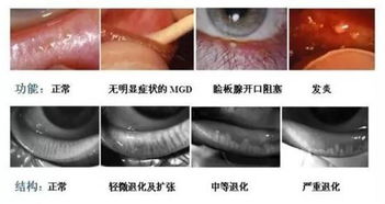 什么是睑板腺功能障碍 来听听邯郸眼科医生的科普 