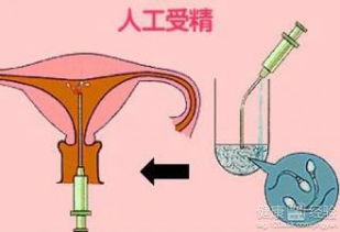 人工受精双胞胎费用大概多少