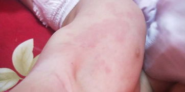 十个月宝宝身上大片红色是过敏吗 