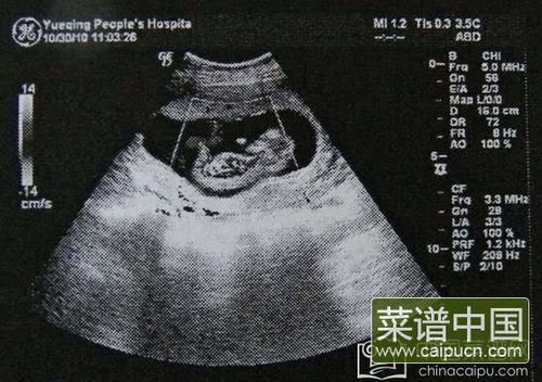 原创怀孕一个月b超图让你一眼看懂b超图