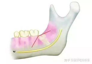 为什么拔智齿要用锤子砸 