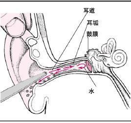 孩子耳屎多,到底该咋办 转载