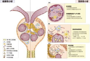 系统性红斑狼疮与狼疮性肾炎的特点及预后