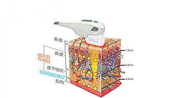 做超声刀影响怀孕吗  第2张