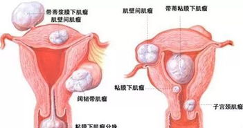 子宫肌瘤 平生最爱 鸠占鹊巢