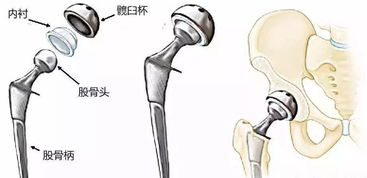 科普 髋关节置换术