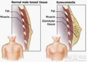 男性乳房发育症如何治疗