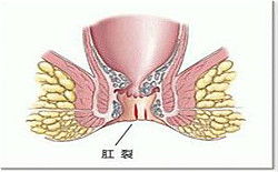 痔疮疼痛和肛裂疼痛有什么区别