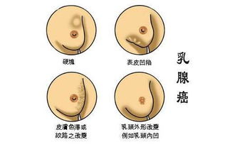 乳腺增生到乳腺癌仅4步 女人别忽视,远离 乳腺癌