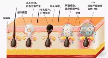 如何去黑头 全面解析去黑头方法6.0进化论