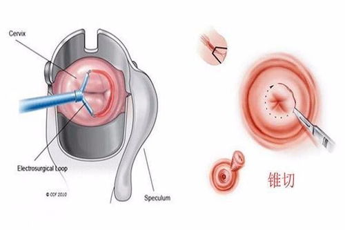 锥切就能让hpv转阴 Hpv转阴的关键点你得知道