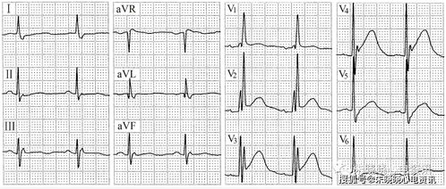 快速解读危急重症心电图 附超多典型案例