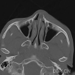 是鼻骨骨折还是上颌骨额突骨折 信息图文欣赏 信息村 K0w0m Com