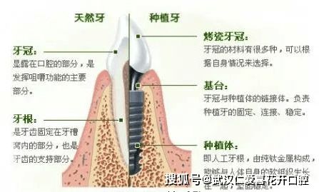 做种植牙前,为什么医生建议先进行牙周治疗