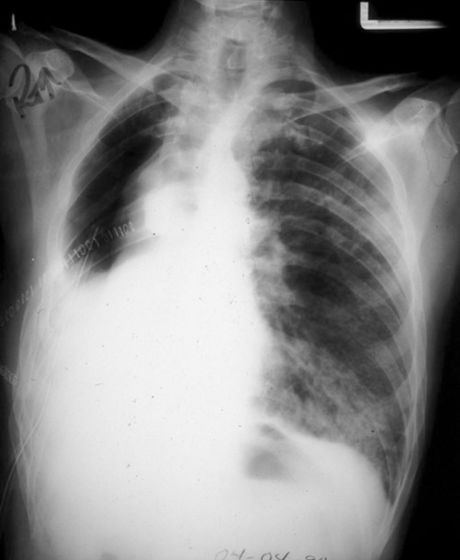病例剖析 肺切除相关肺损伤