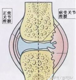 白酒加它泡,不用怕膝盖 滑膜炎 痛的不能走路 用十个好十个 