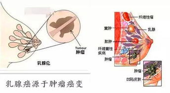 乳腺红外热成像检查结果