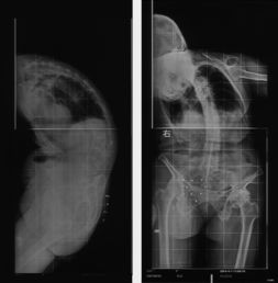 陶惠人教授 老年性脊柱侧弯手术案例展示