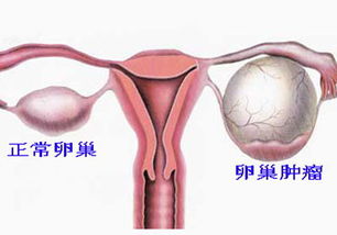 卵巢囊肿,对怀孕有影响吗 