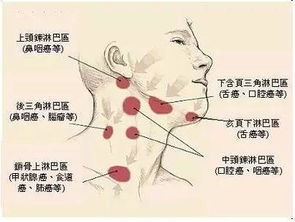 颈部淋巴结肿大怎么办，脖子淋巴结肿大怎么办啊!