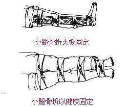 手肘骨折夹板固定方法 表情大全