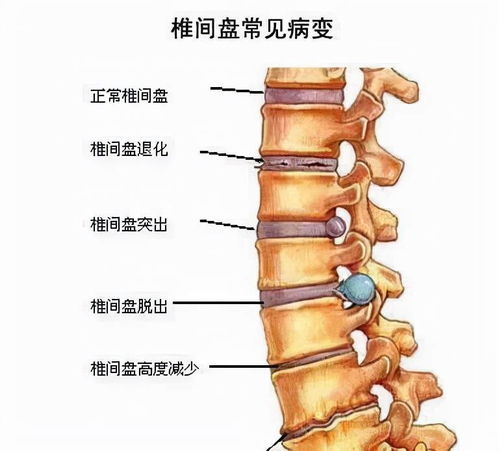 年纪轻轻就腰椎间盘突出了 能否自愈 早期出现这几种症状要留意