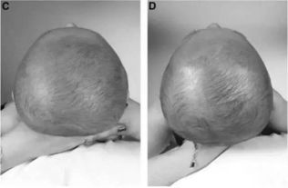烦恼 宝宝把头睡平了,还能再睡圆吗 