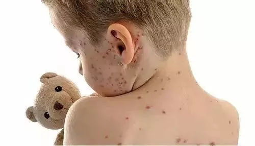 水痘高发季 一个孩子能传染全班 大人孩子都传染,有这些症状要小心 