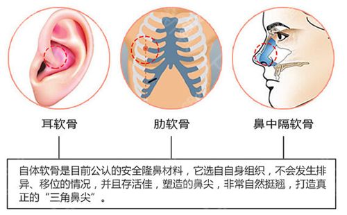 上海哪些医生做肋骨鼻比较好 九院戴传昌隆鼻技术咋样