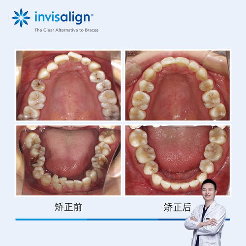 为什么不能随随便便拔牙(为什么不能轻易拔牙)